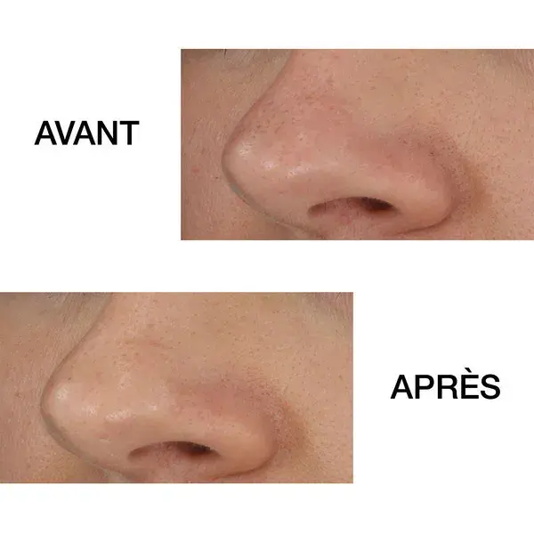 Clinique Blackhead Solutions Extrator de Cravos Autoaquecido 20ml