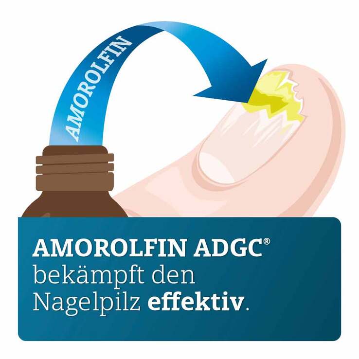 Amorolfin ADGC 50 mg / ml wirkstoffhalt.Nagellack, 3 ml
