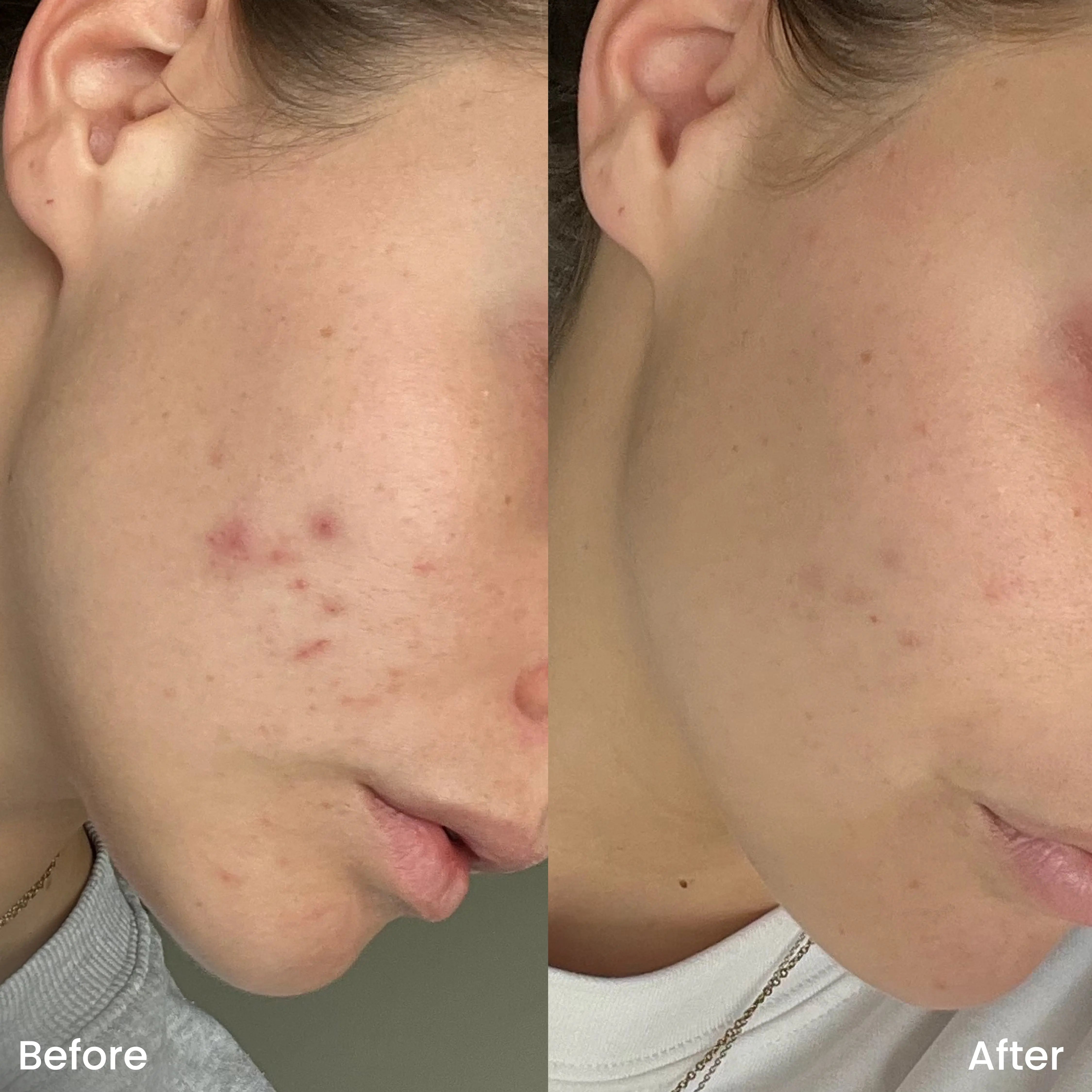 Spot Treatment Gel