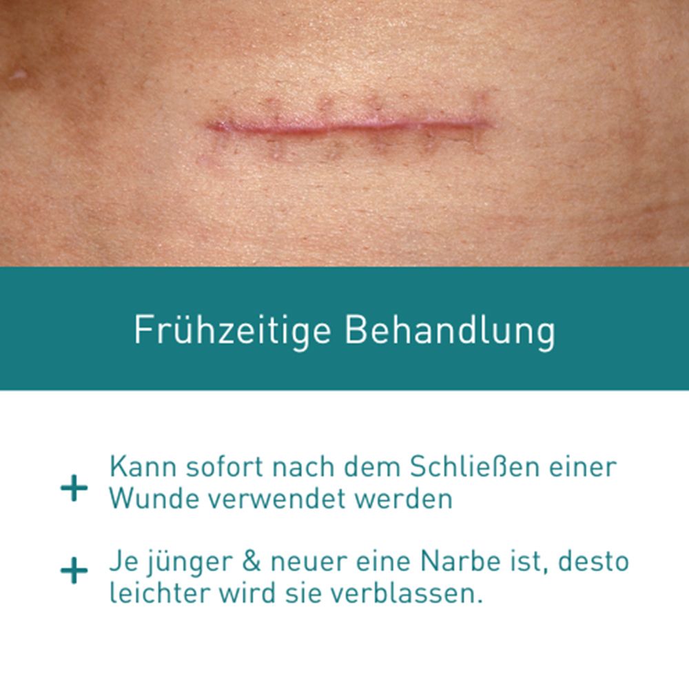 N1 Narbengel – reduziert Hautverdickungen, Rötungen, Verfärbungen & Schmerzen
