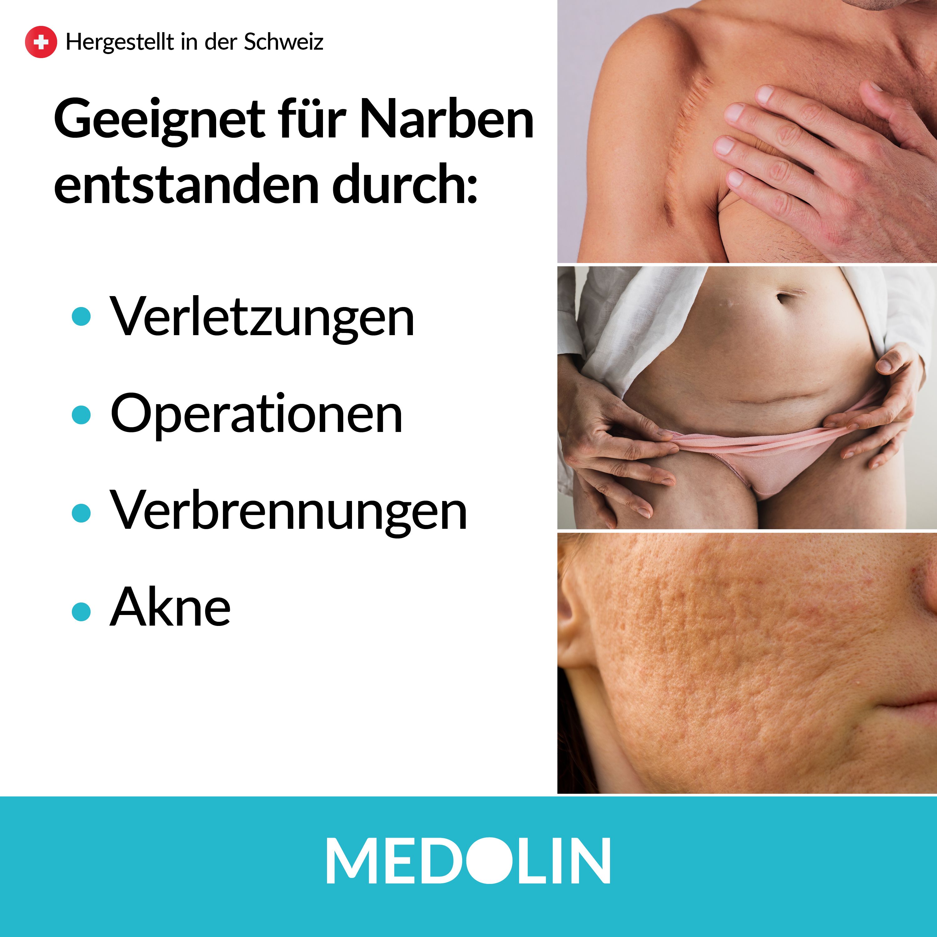 Medolin® Narbengel - Narbensalbe reduziert die Sichtbarkeit von Narben - Effektive Narbencreme