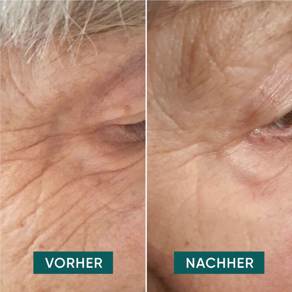 APRICOT Augen-Schläfen Pads mit Hyaluron für Hautstraffung