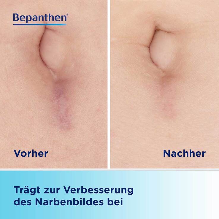 Bepancare Narben-Gel, 20 ml
