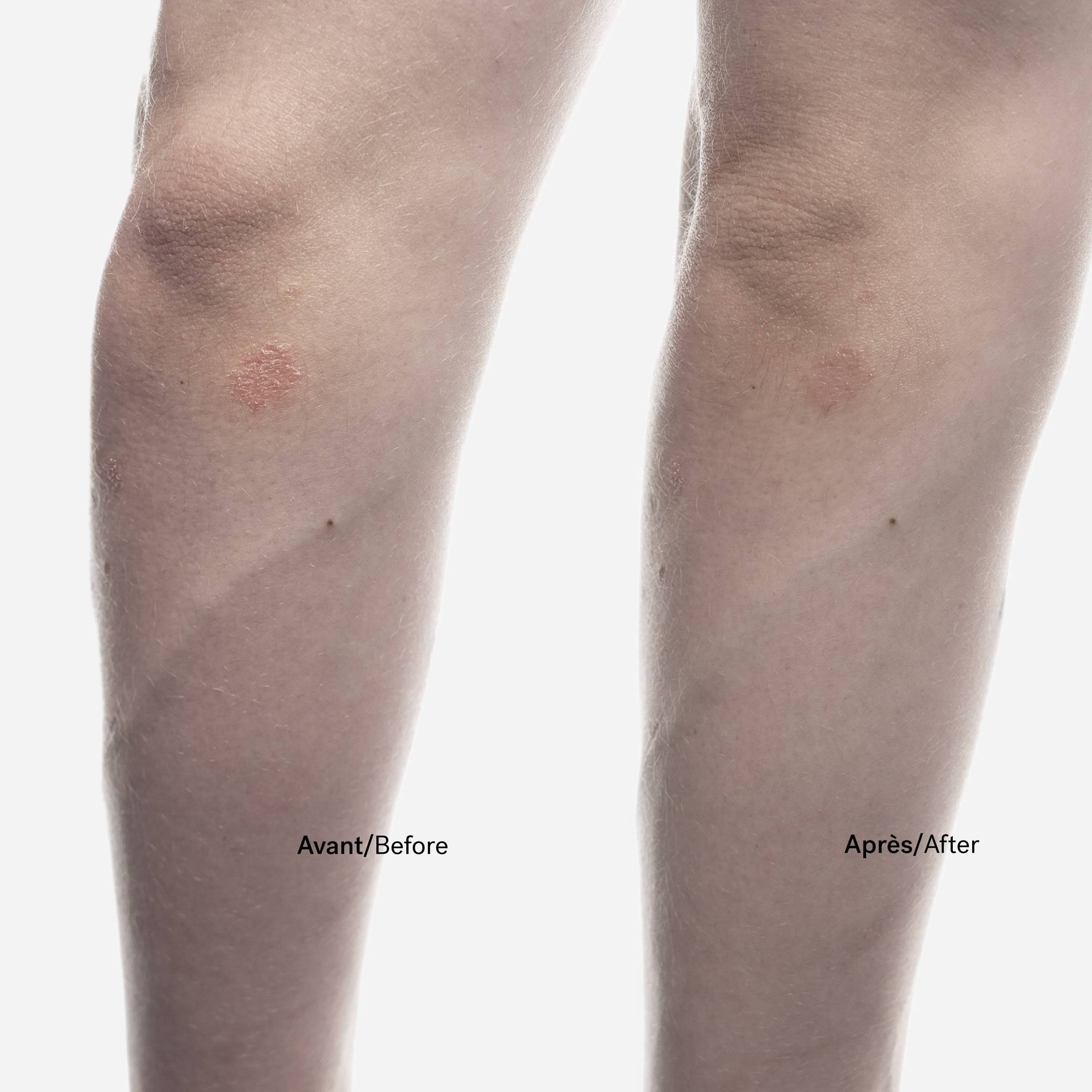 Duo de soins peaux sujettes au psoriasis