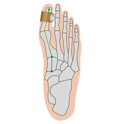 Fussgut Hallux-Bandage »Softkissen mit Fixierband, verhindert Reiben« Druckentlastung bei Hühneraugen, Schwielen, Entlastung Hallux Valgus
