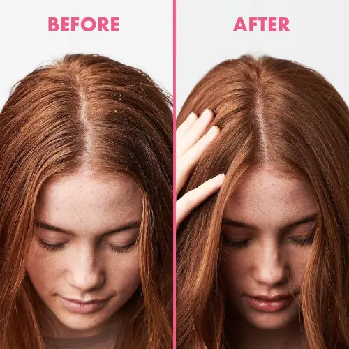Scalp Rescue Soothing Anti Dandruff Scalp Mask