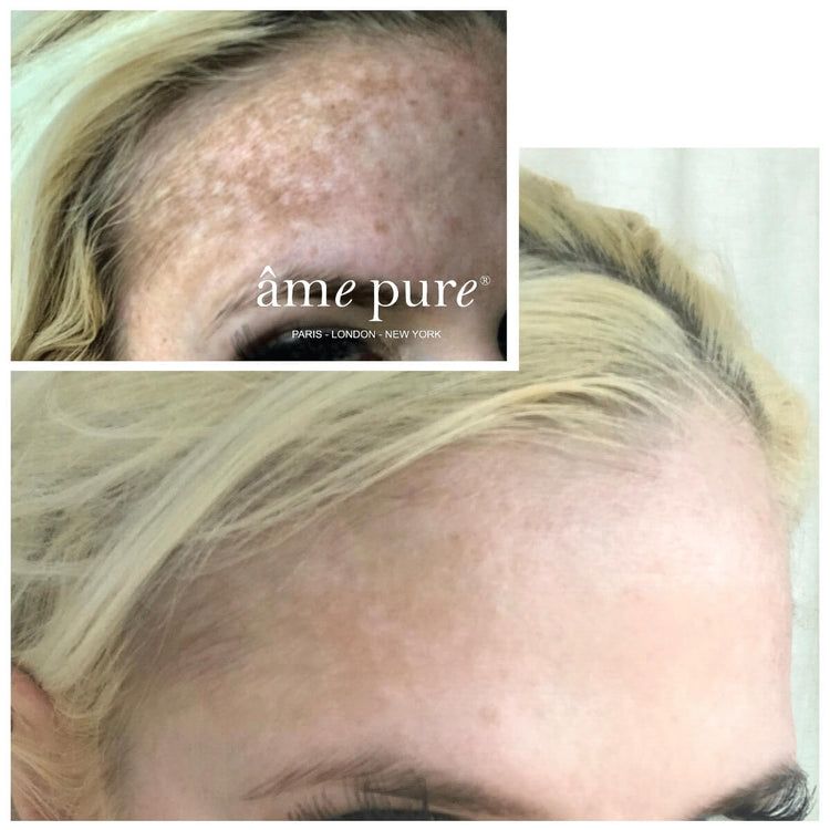 âme pure WrinklEraser BASIC