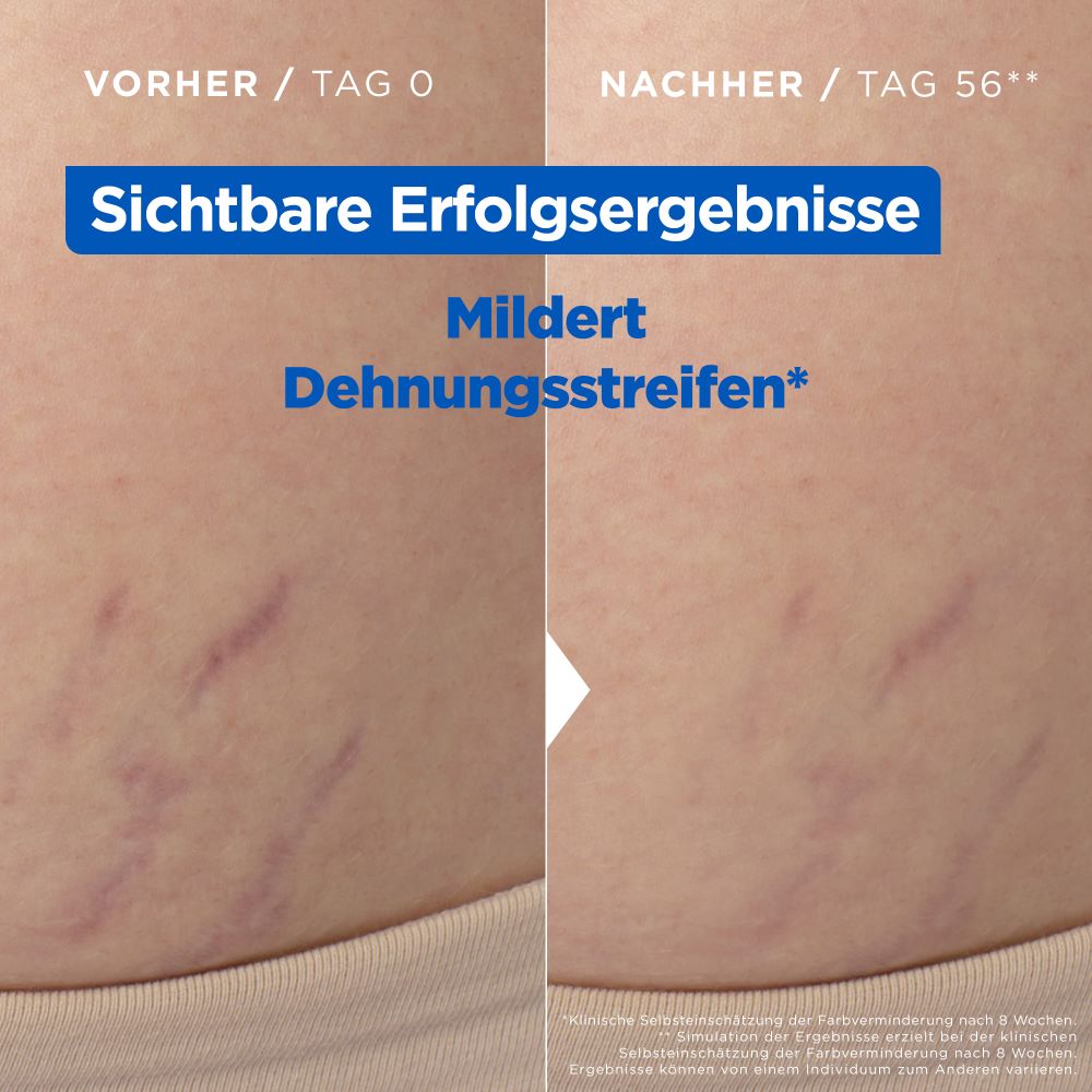 MIXA Niacinamide Stretchmark Oil<br>100 ml, Öl