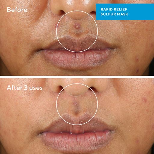 Murad Rapid Relief Acne Sulfur Mask, 75 ml