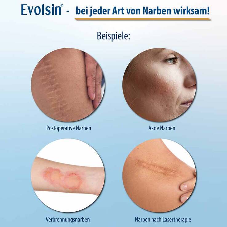 Evolsin Narbenpflaster 2,5cm x 200cm, 1 St
