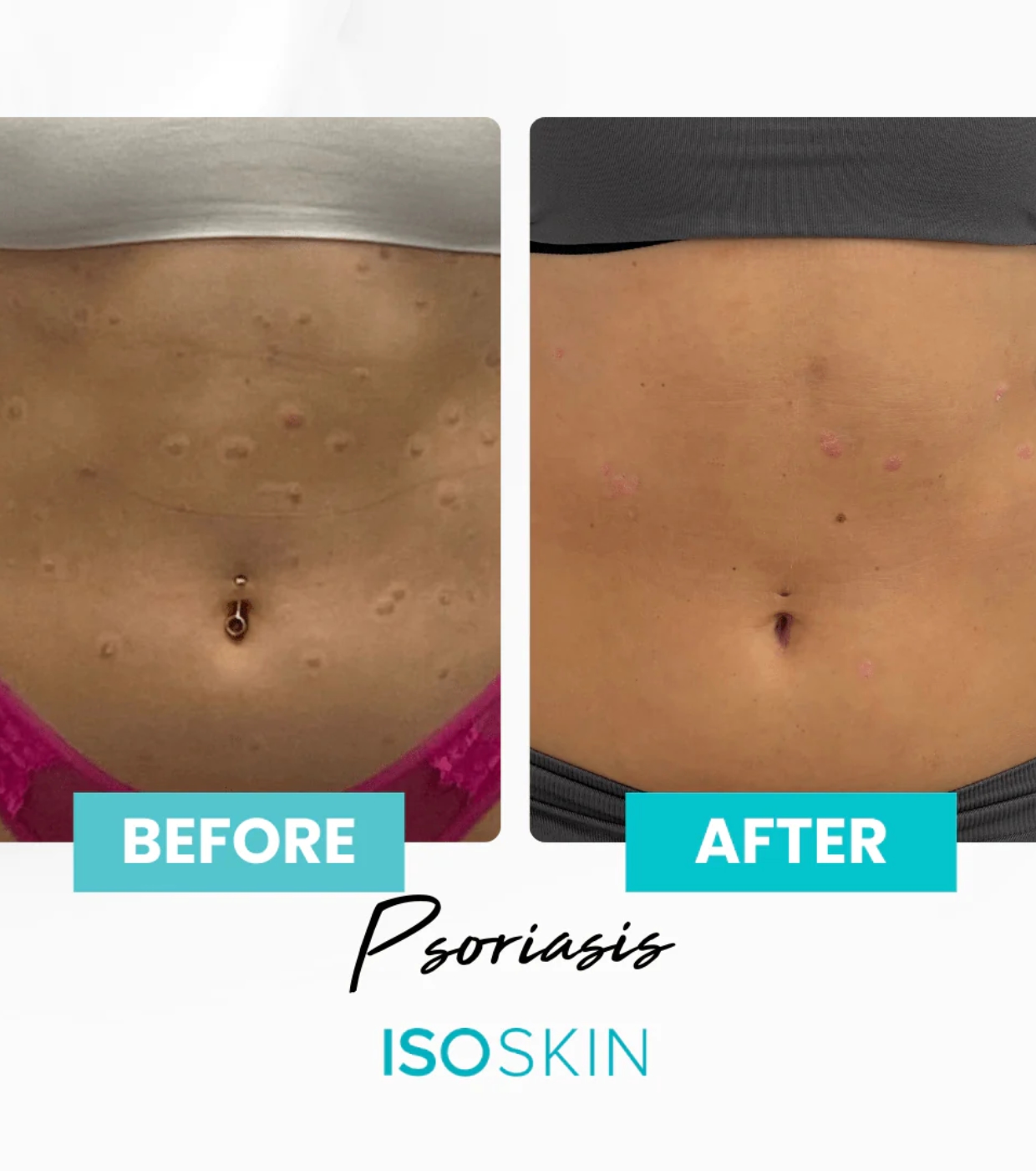 ISOCLEAN - *ISOSKIN* - Spray facial e corporal Hypochlorous - 100ml