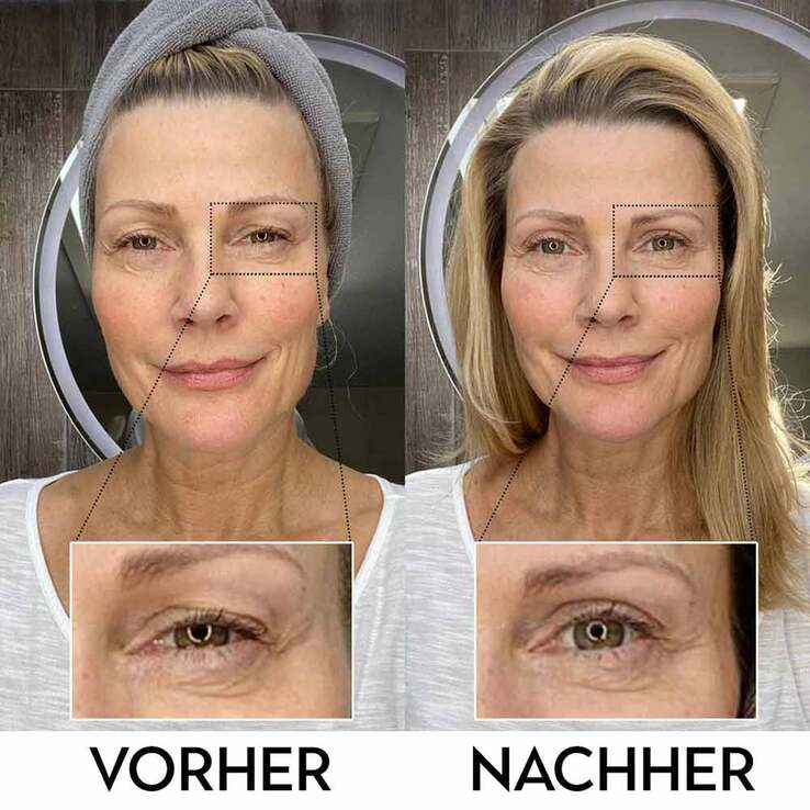 Lidperfect Augengel bei Schlupflidern, 15 ml
