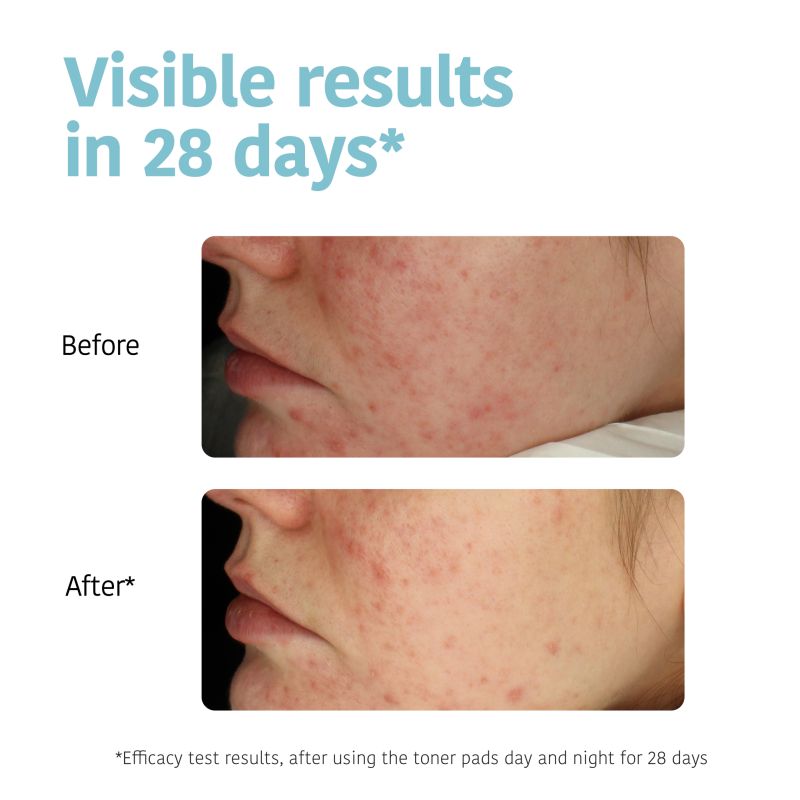 Disques Toniques Exfoliants & Anti-Imperfections-Acné Iroha x50