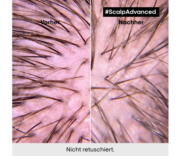 L'Oréal Professionnel Scalp Advanced Anti-Discomfort Treatment