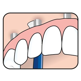TePe Universal Care - Speciale Tandenborstel 1ST