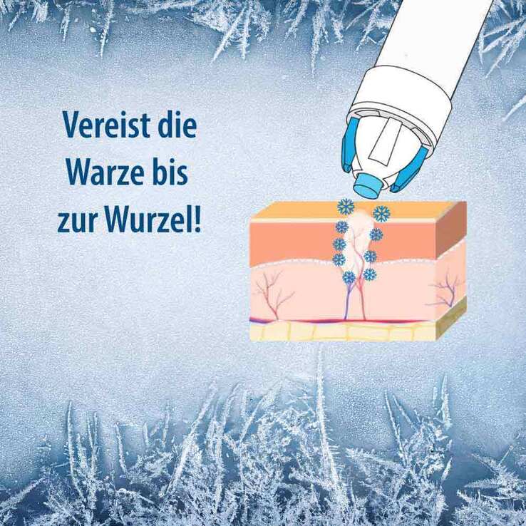 Evolsin® Warzenvereiserspray, 75 ml