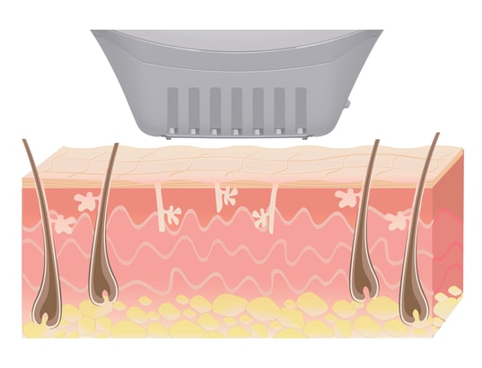 BEURER - Epilateur lumière pulsée IPL 1000+ SalonPro 250000 impulsions