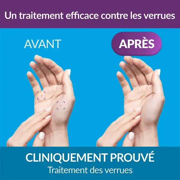 Excilor Verruxit Cryo Tratamento para Verrugas nas Mãos e nos Pés 50ml