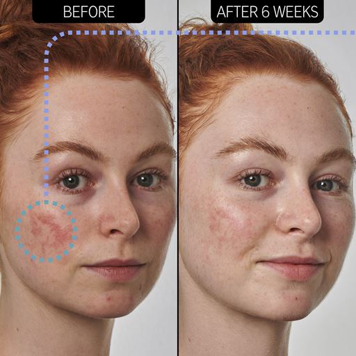 The Inkey List 10% Azelaic Acid Serum, 30 ml