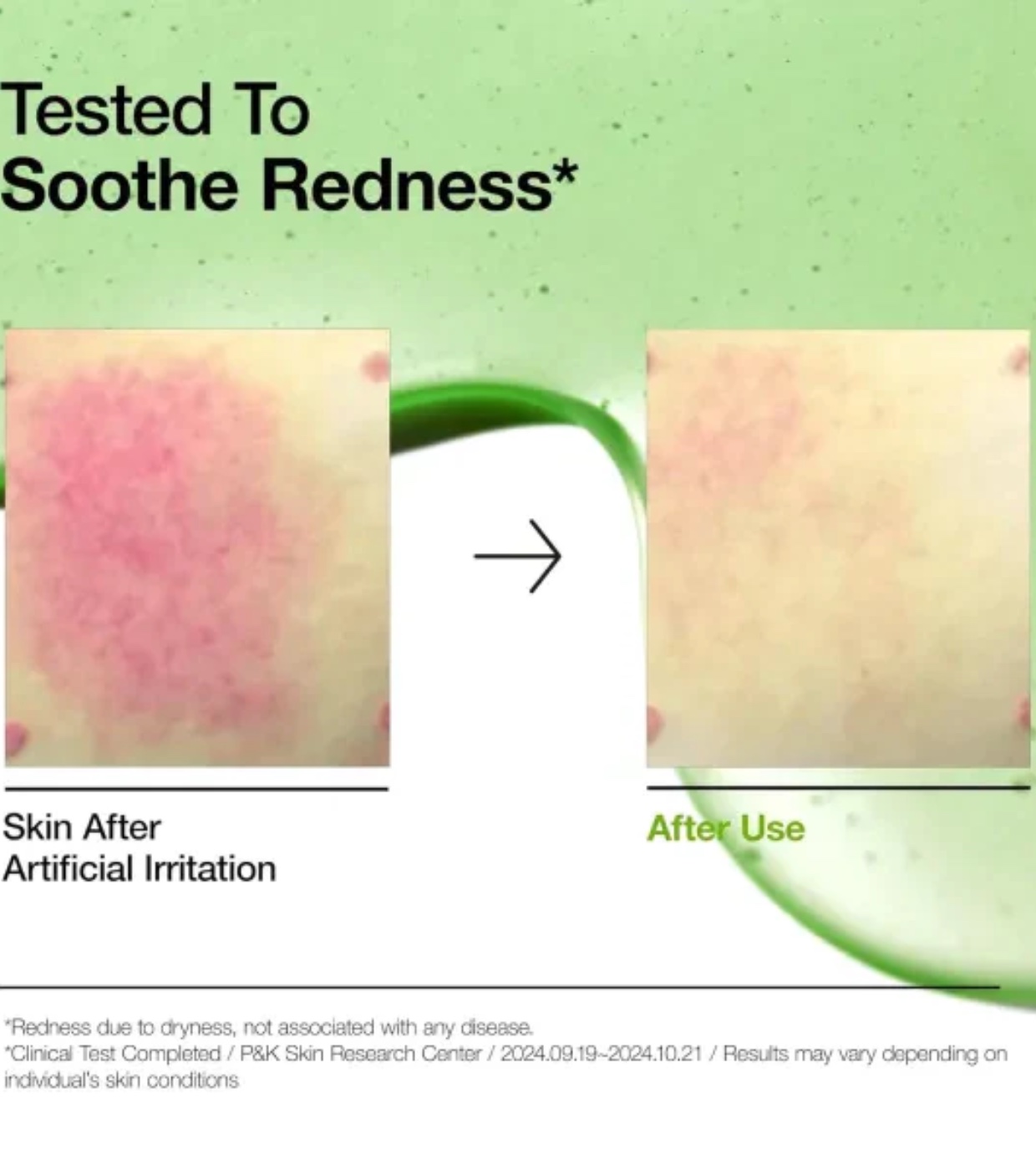 Anua - Sérum antiacne com 10+ ácido azelaico e ácido hialurônico