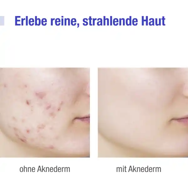 Hautgetönte mattierende Pflegecreme gegen Hautunreinheiten