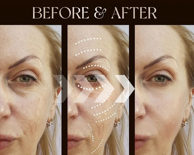 ANLAN - Multifunctioneel RF Beauty Device Pro