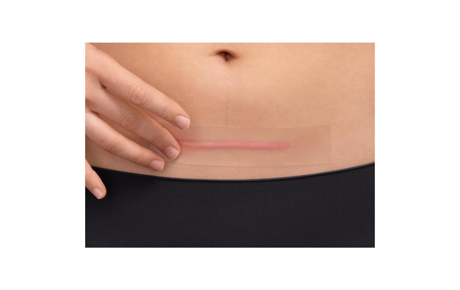 Narbenpflaster Narben Reduktion XL 21 StückPflaster zur Narbenbehandlung