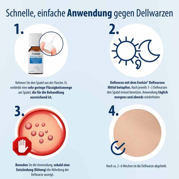 Evolsin Dellwarzen Mittel Lösung, 5 ml