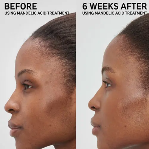 Mandelic Acid Treatment