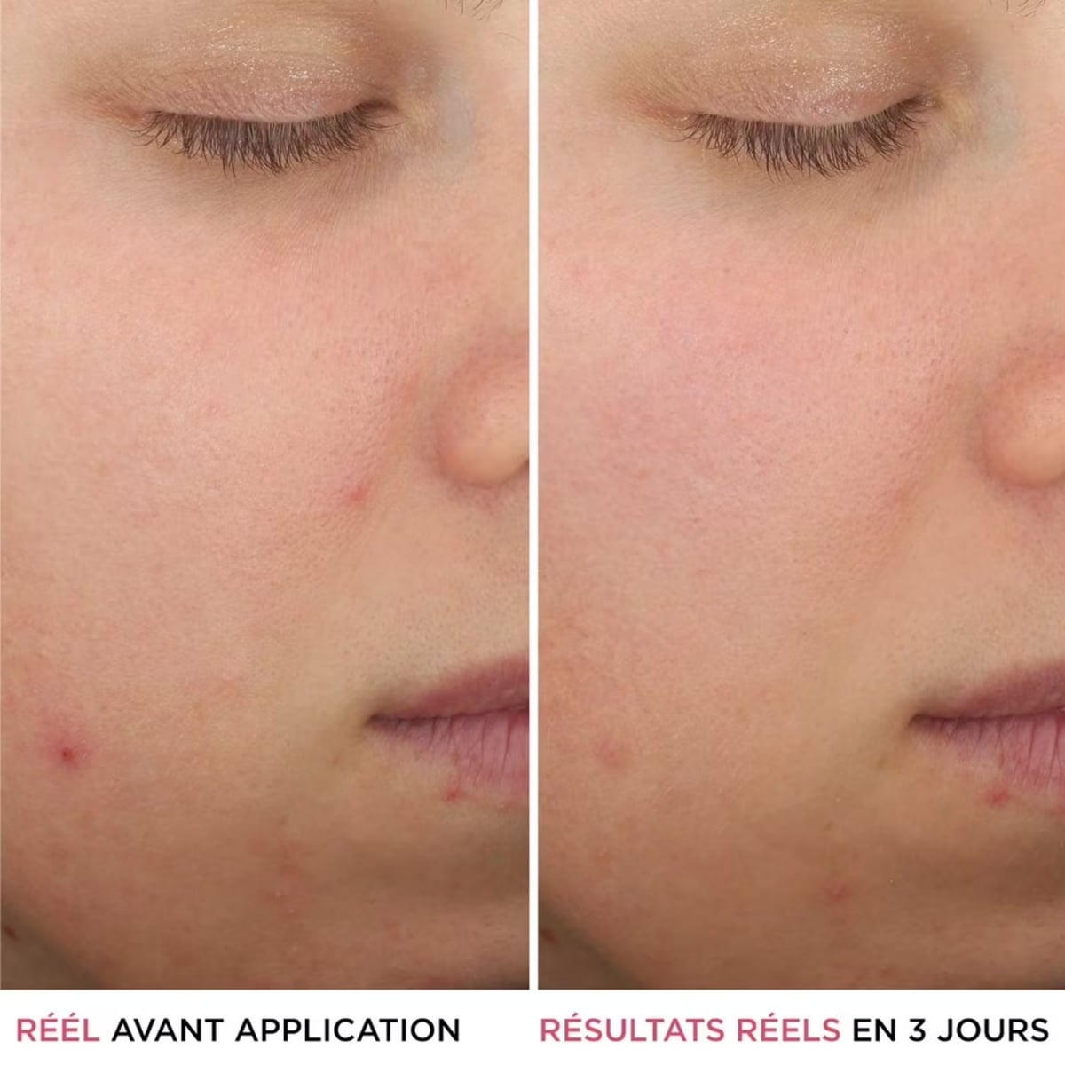 It Cosmetics Bye Bye Breakout Sérum anti-acné à l'acide salicylique