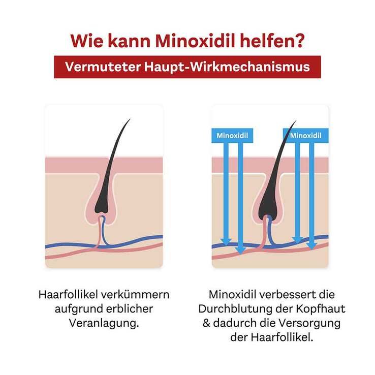 MINOXIDIL DoppelherzPharma 50 mg/ml Lösung für Männer, 2x3x60 ml