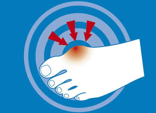 epitact Epithelium 26® Hallux valgus-Schutz