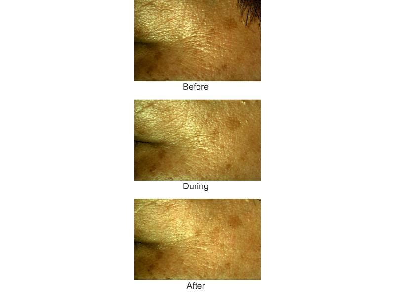 Silk'n Antiaging-Gerät FaceTite Mini Hautverjüngungs Gerät mit HT – Technologie
