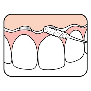 TePe Bridge & Implant Floss 30ST