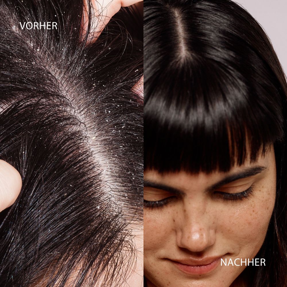 DUCRAY KELUAL DS Shampoo – Anti-Schuppen-Shampoo bei hartnäckigen Schuppen, seborrhoischer Dermatitis und Kleienpilzflechte