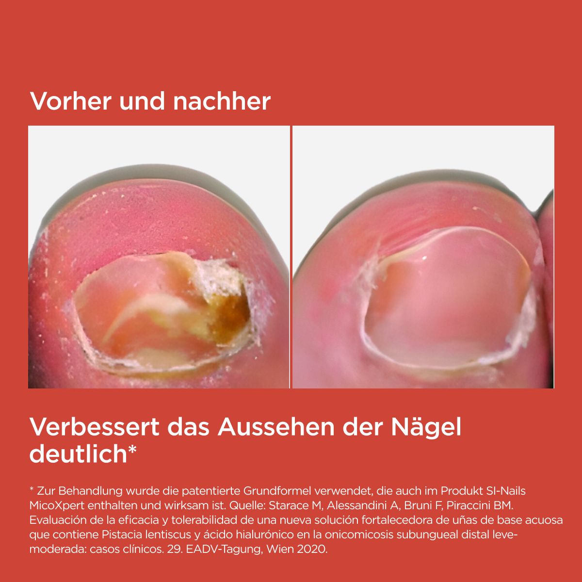 ISDIN SI-NAILS® MicoXpert Nagelstift bei Nagelpilz