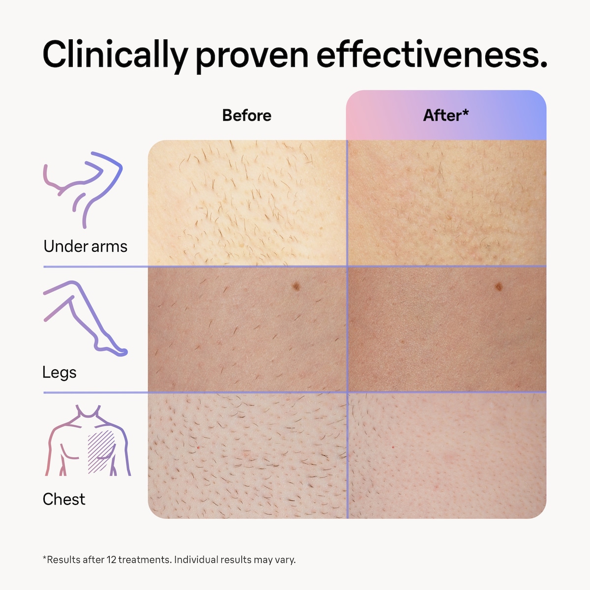 Braun Smart IPL Skin i-Expert Pro 7 hårfjernerlys PL7249