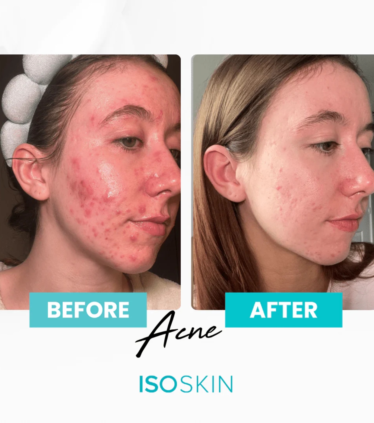 ISOCLEAN - *ISOSKIN* - Spray facial e corporal Hypochlorous - 100ml