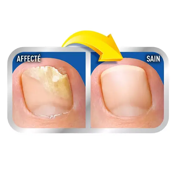 Sistema de solução para fungos nas unhas 2 em 1 da Scholl