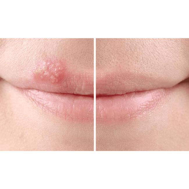 SoreFix Rescue Op Zink Gebaseerde Koortslipcrème 6 ML