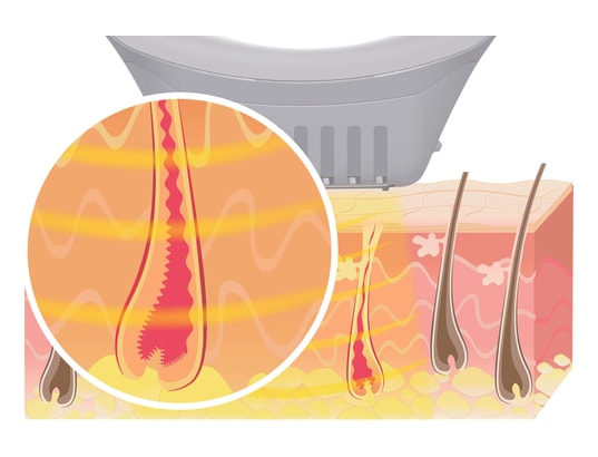 BEURER - Epilateur lumière pulsée IPL 1000+ SalonPro 250000 impulsions