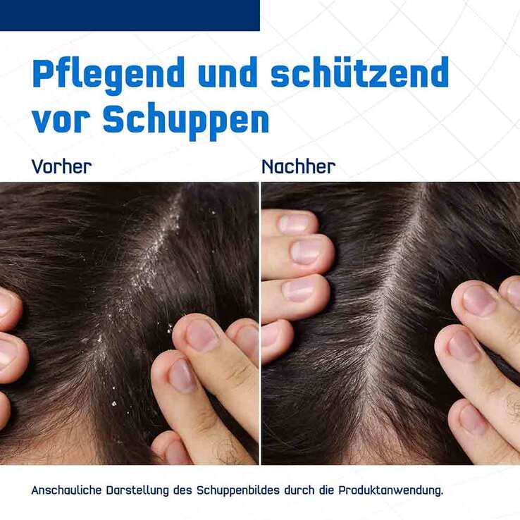 Terzolin Expert Shampoo bei fettiger Kopfhaut, 200 ml