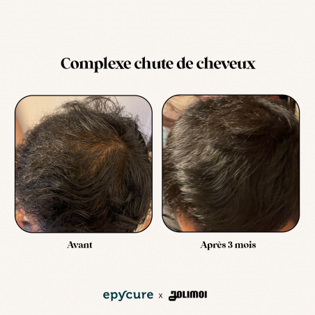 Epycure Laboratoire Complexe chute de cheveux hommes 3 mois