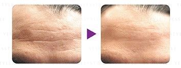 Zino - Anti-Age Elastine Lift Filler Essence