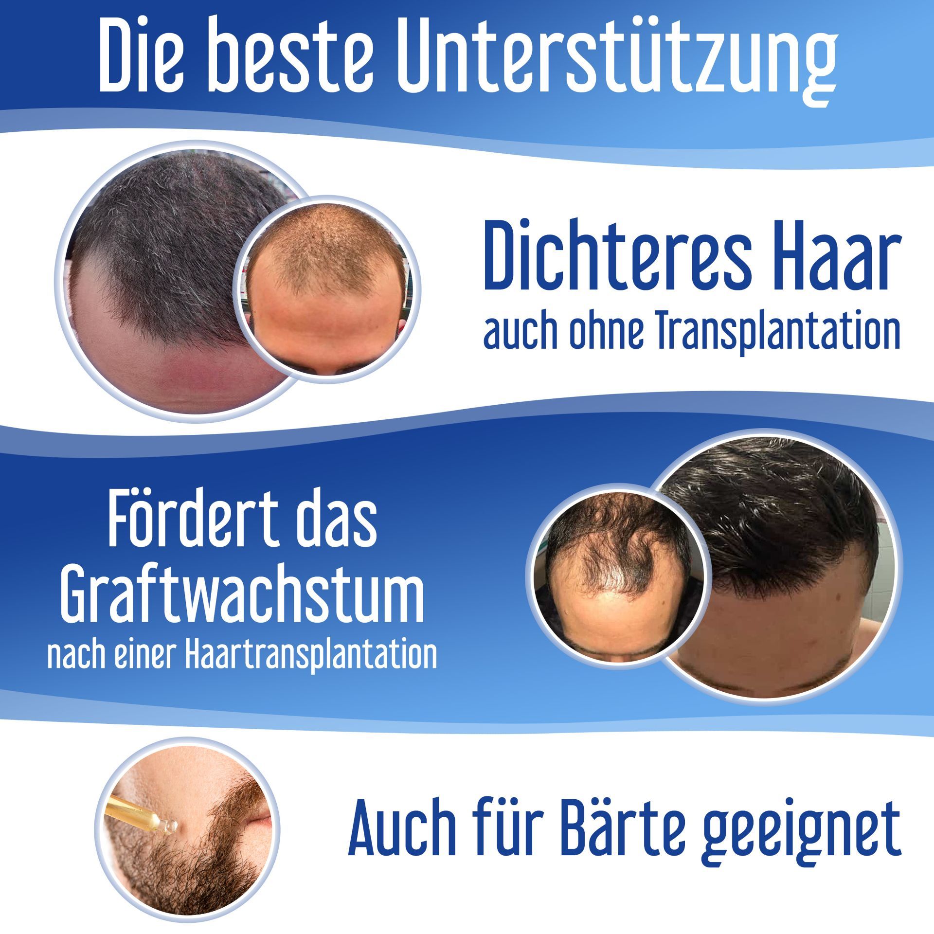 Hairforte Spray 3% Procapil gegen Haarverlust DHT Blocker