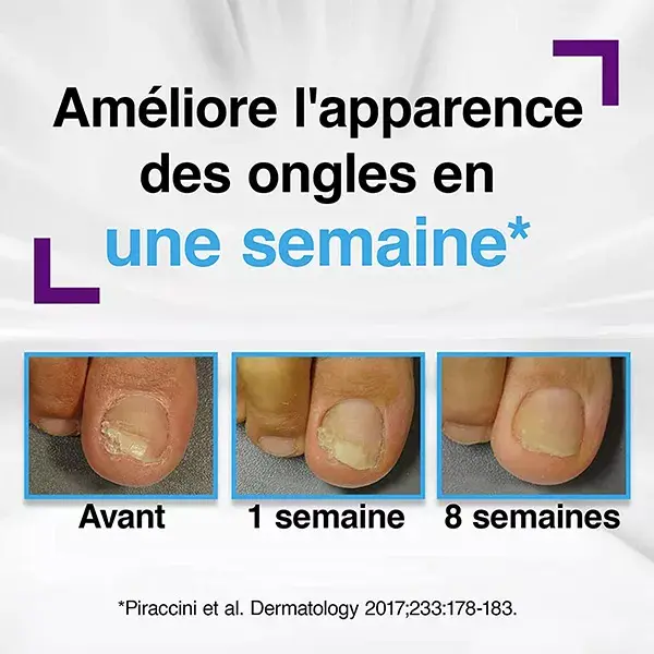 Emtrix® Tratamento para Micose de Unha ou Psoríase 10 ml