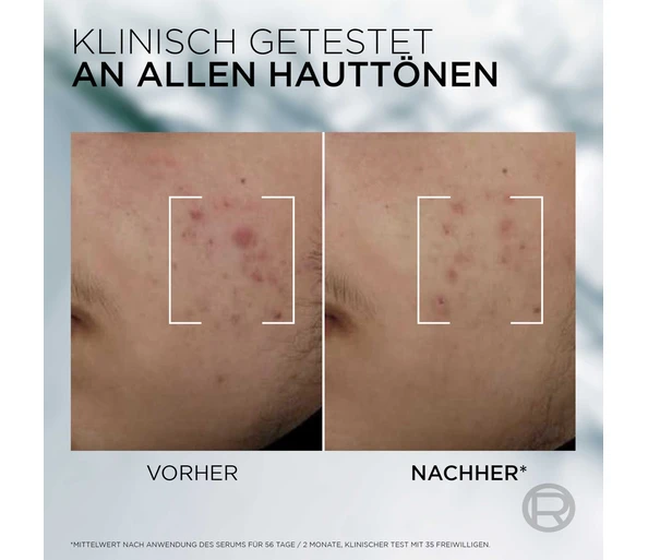 L'ORÉAL PARIS Derma Control Anti-Unreinheiten Serum