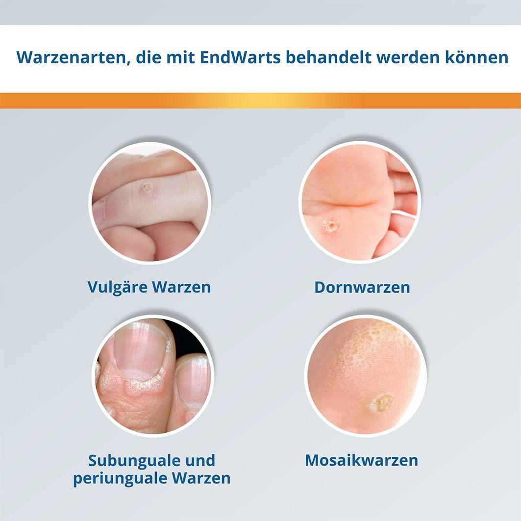 EndWarts CLASSIC: Lösung mit Ameisensäure gegen Warzen und Dornwarzen, Warzenbehandlung für Hände und Füße