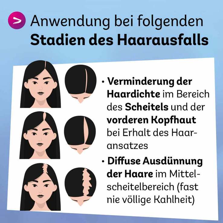Minoxidil Dexcel 20 mg / ml Spray z.Anw.a.d.Kopfhaut, 60 ml