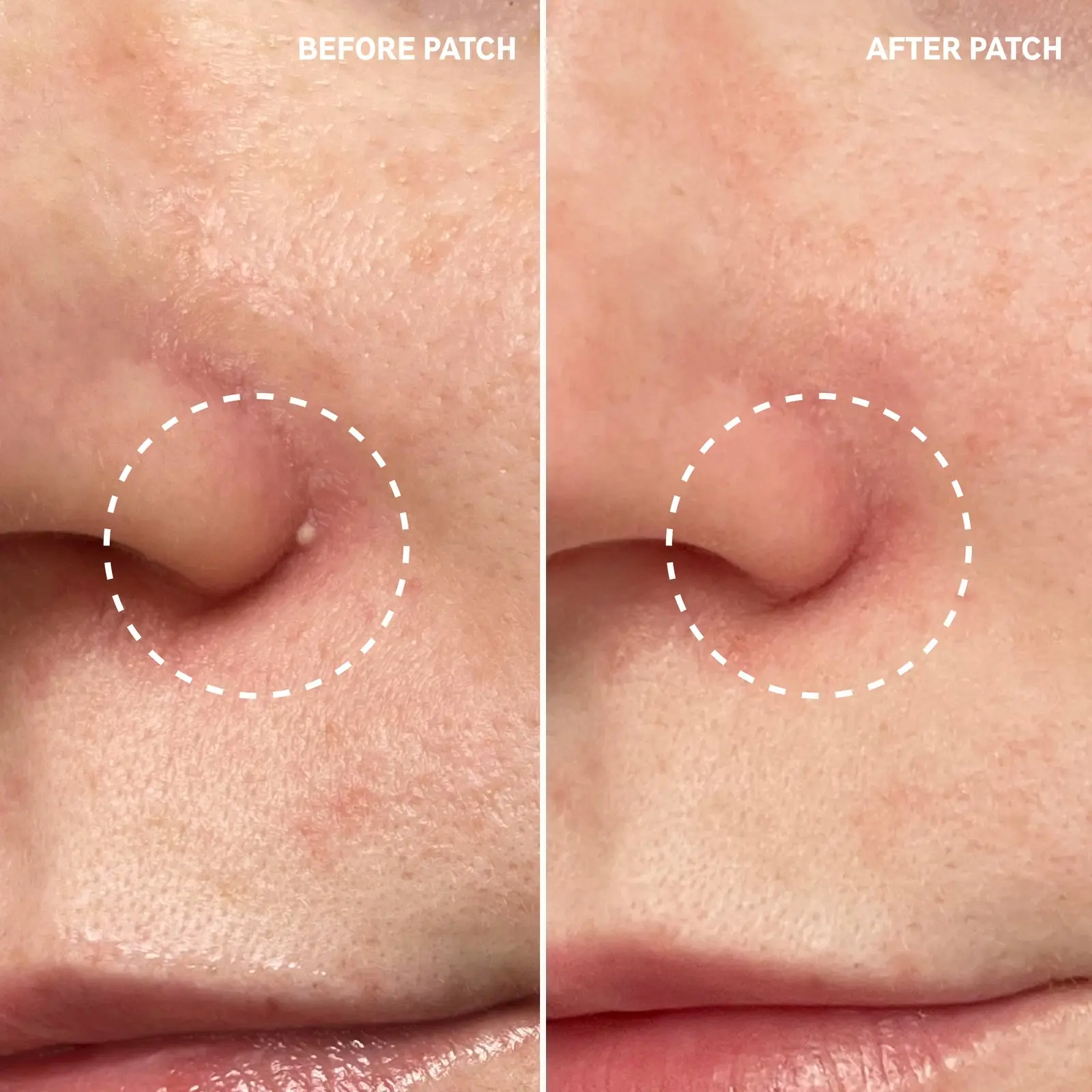 Hydrocolloid Invisible Pimple Patches